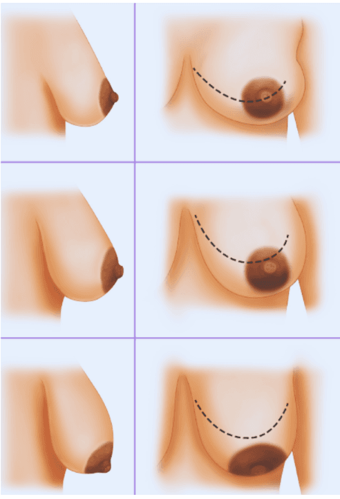 Lifting, Breast Lift, Mastopexy, Reduction, Augmentation